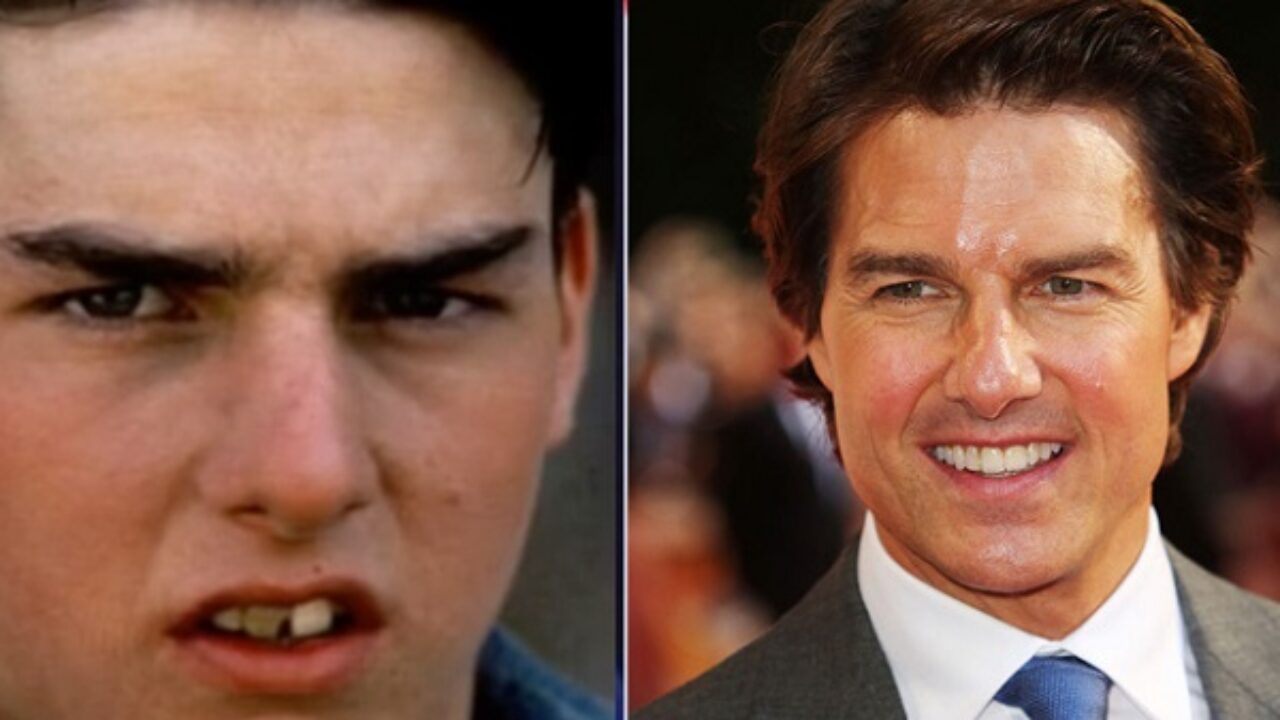 Un sourire de star Sourire de star avant après