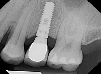 Les implants dentaire assurent une stimulation osseuse